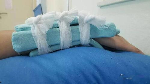 骨折的夹板固定视频